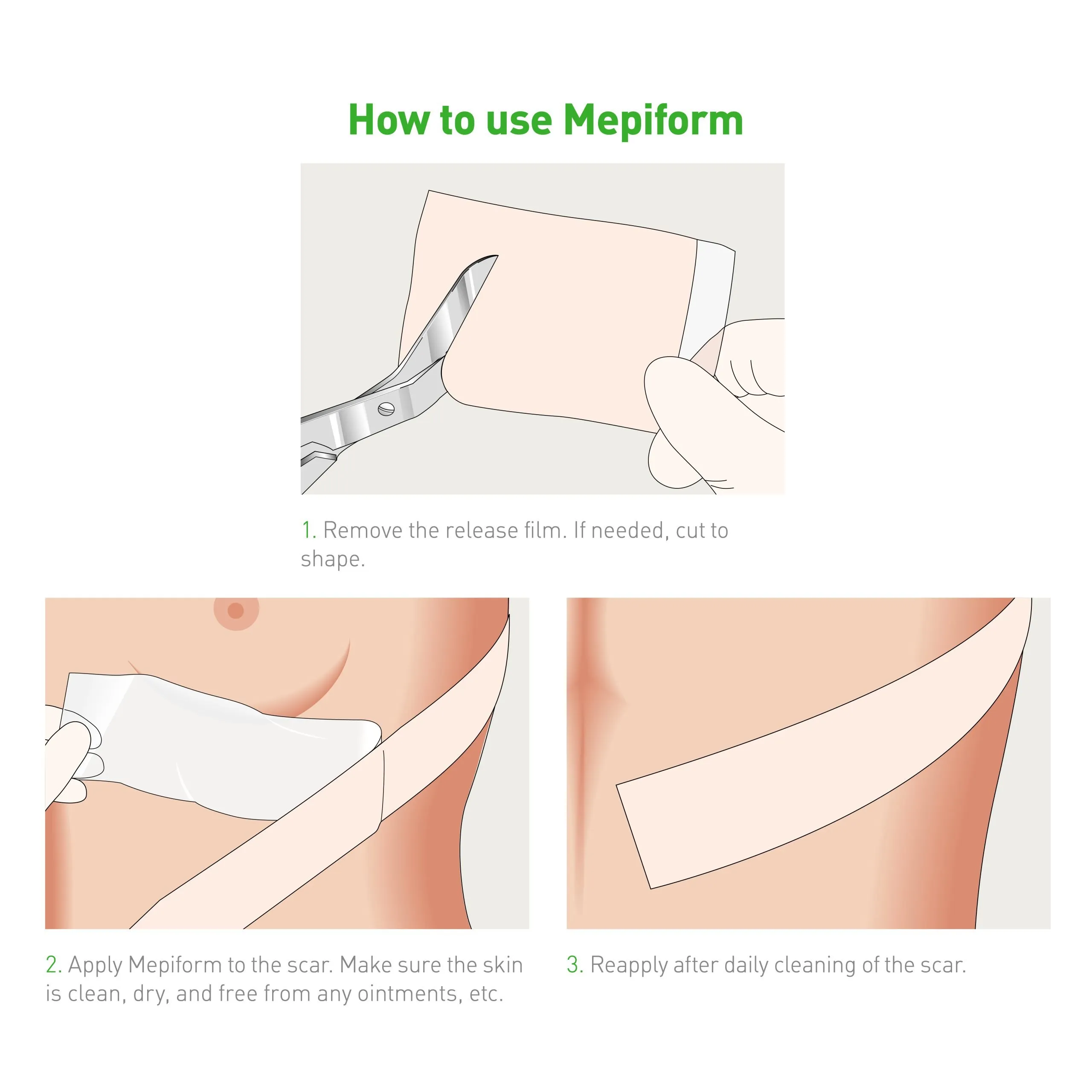 Mepiform Scar Reduction Dressings - Image 7